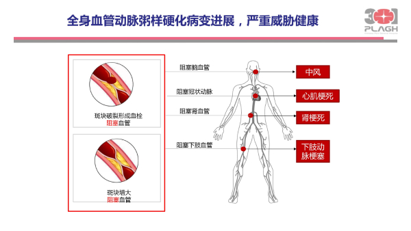 光明卫生·科普脱口秀|叶平：血脂异常，不仅仅是化验单上的箭头朝向